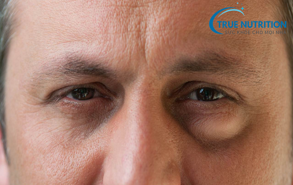 Tiểu Đường Bị Phù Mắt