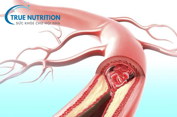 Tại sao tiểu đường gây xơ vữa động mạch