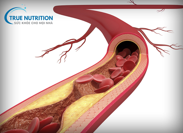 Tại sao tiểu đường gây xơ vữa động mạch