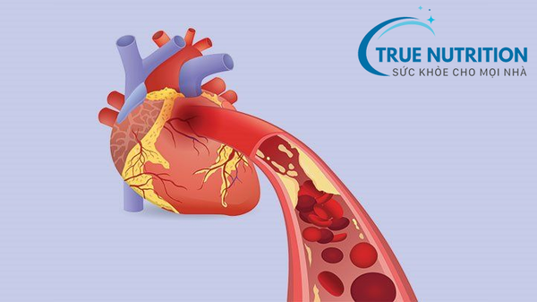 Tiểu Đường và Tim Mạch