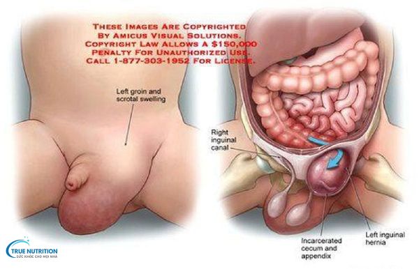 Hình Ảnh Thoát Vị Bẹn Ở Bé Trai: Nhận Biết, Phân Biệt Và Điều Trị
