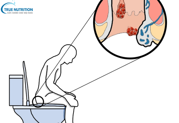 Bệnh Trĩ: Những Điều Cần Biết Để Chữa Trị và Phòng Ngừa Thành Công