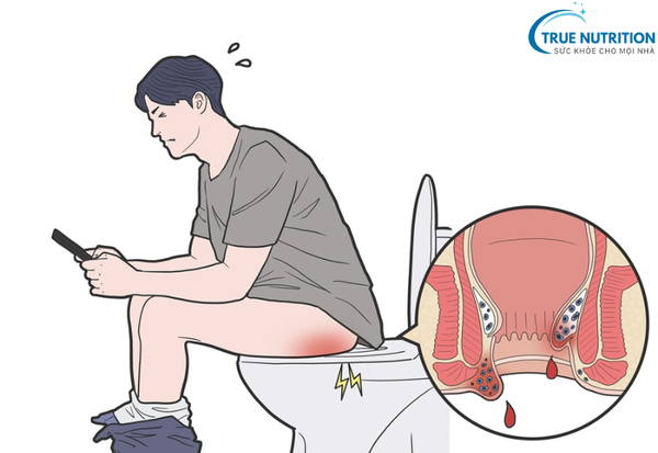 Bệnh Trĩ: Những Điều Cần Biết Để Chữa Trị và Phòng Ngừa Thành Công