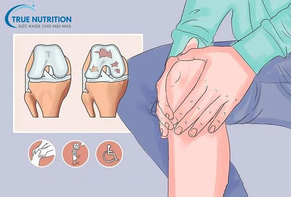 Bệnh thoái hóa khớp gối