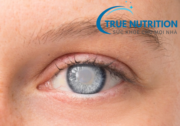 Đục Thủy Tinh Thể Do Tiểu Đường