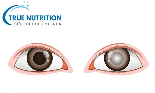 Đục Thủy Tinh Thể Do Tiểu Đường