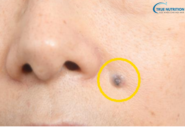 Dấu Hiệu Bệnh Ung Thư Da: Cách Phát Hiện Sớm và Ngăn Ngừa Hiệu Quả