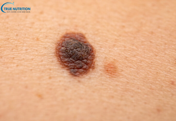Dấu Hiệu Bệnh Ung Thư Da: Cách Phát Hiện Sớm và Ngăn Ngừa Hiệu Quả