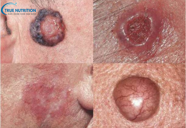 Dấu Hiệu Bệnh Ung Thư Da: Cách Phát Hiện Sớm và Ngăn Ngừa Hiệu Quả