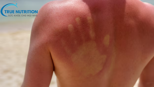 triệu chứng bỏng nắng