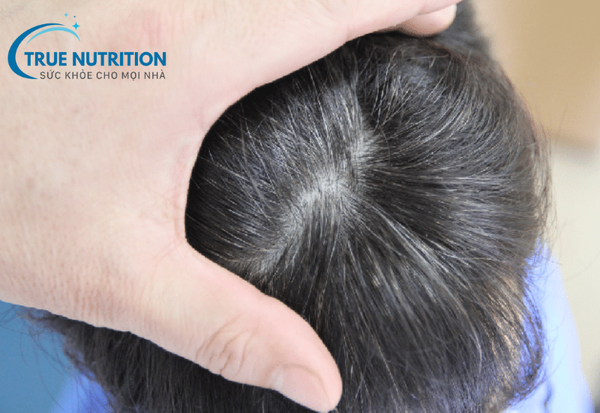 Tóc Bạc Sớm: Nguyên Nhân và Cách Khắc Phục Hiệu Quả