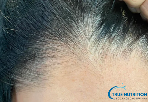 Tóc Bạc Sớm: Nguyên Nhân và Cách Khắc Phục Hiệu Quả