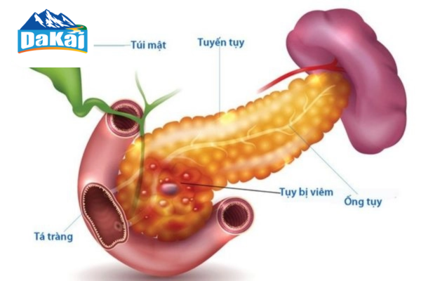 Bệnh viêm tụy có nguy hiểm không? Cách phòng ngừa viêm tụy