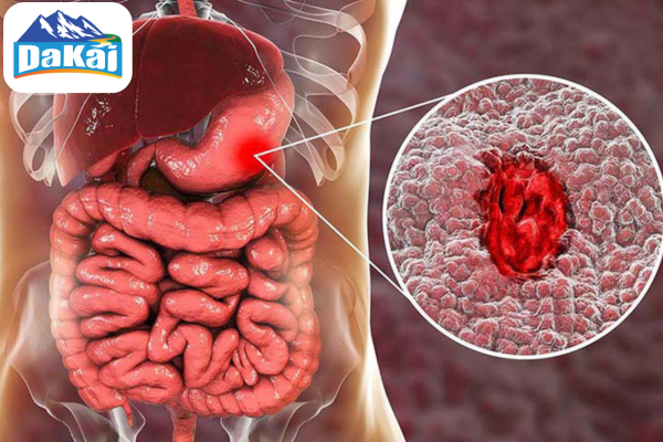 Chảy máu dạ dày có nguy hiểm không? Nguyên nhân và dấu hiệu nhận biết