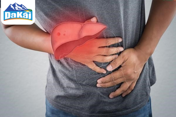 Gan nhiễm mỡ cấp độ 3 là gì? Nguyên nhân và dấu hiệu cảnh báo