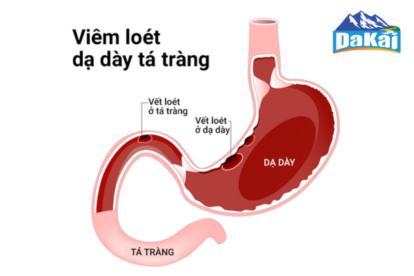 Viêm loét dạ dày tá tràng: Nguyên nhân và triệu chứng thường gặp
