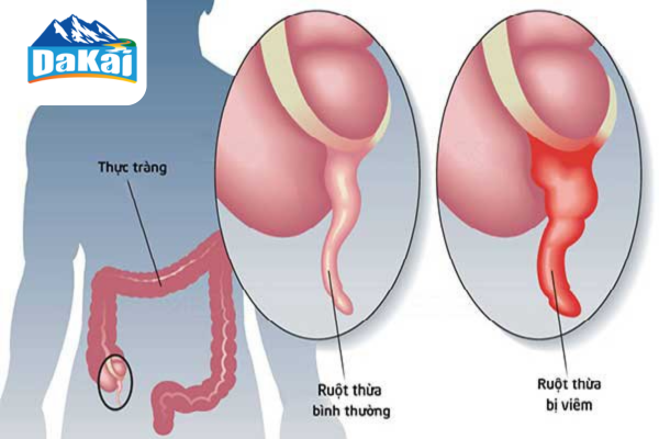 Ruột thừa là gì? Vị trí của ruột thừa trong cơ thể