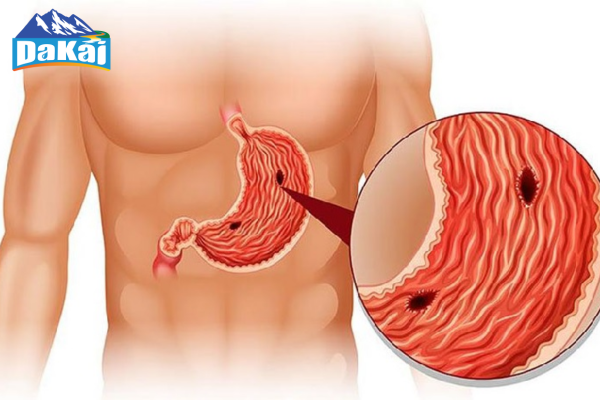 Nguyên nhân và triệu chứng bệnh viêm dạ dày cấp cần lưu ý