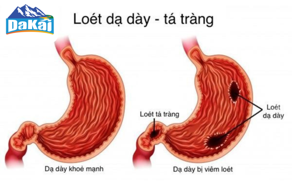 Biểu hiện cảnh báo bệnh viêm dạ dày tá tràng bạn cần lưu ý
