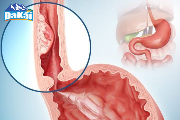 Nguyên nhân và triệu chứng dẫn đến tình trạng viêm thực quản trào ngược dạ dày độ B