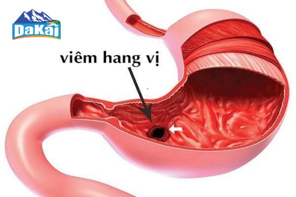 Viêm Xung Huyết Hang Vị Dạ Dày: Nguyên Nhân, Biểu Hiện Và Cách Phòng Bệnh