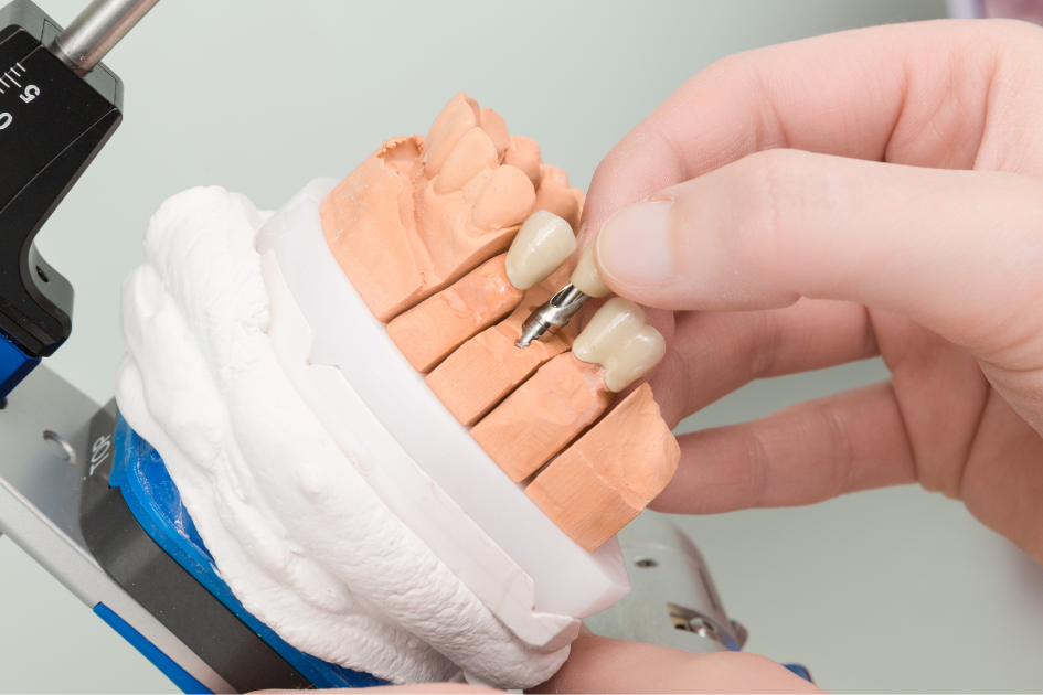 Địa Chỉ Mua Implant Chất Lượng Giá Tốt Ở Bình Thuận
