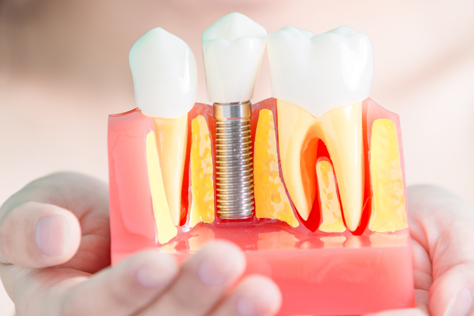 Địa Điểm Mua Implant Chất Lượng Tại Quận Bình Tân Ở Đâu?
