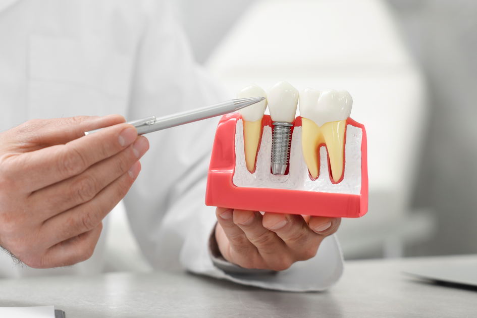 Nơi Mua Implant Giá Tốt Tại Quận Bình Thạnh Ở Địa Chỉ Nào?