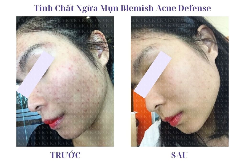 Phản hồi Tinh Chất Ngừa Mụn Blemish Acne Defense KA GCG