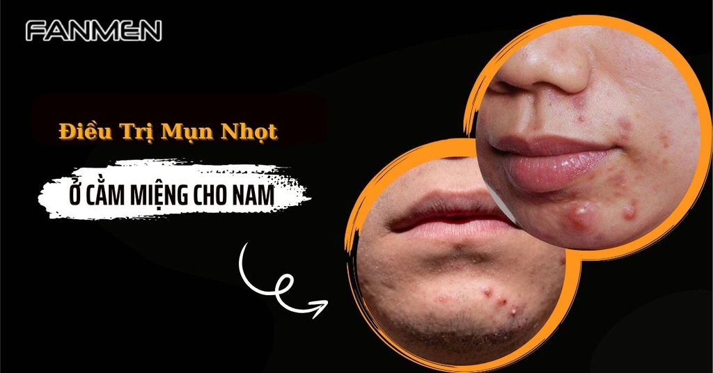 điều trị mụn nhọt ở cằm miệng cho nam