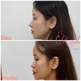 NÂNG MŨI SỤN TỰ THÂN VỚI TS. KIỀU THƠ