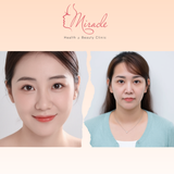 CĂNG CHỈ DA MẶT TỰ NHIÊN