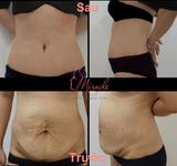 PHẪU THUẬT TẠO HÌNH THÀNH BỤNG (TƯ VẤN)