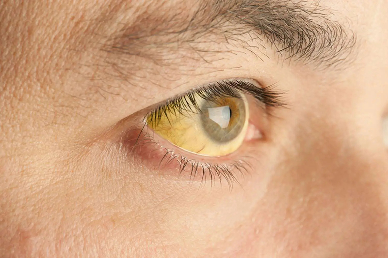 vàng mắt là 1 biểu hiện của gan nhiễm mỡ