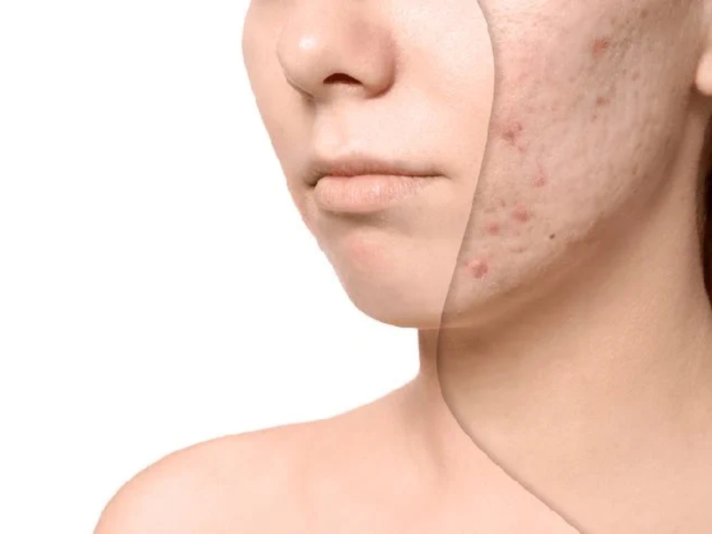 Các phương pháp điều trị sẹo mụn