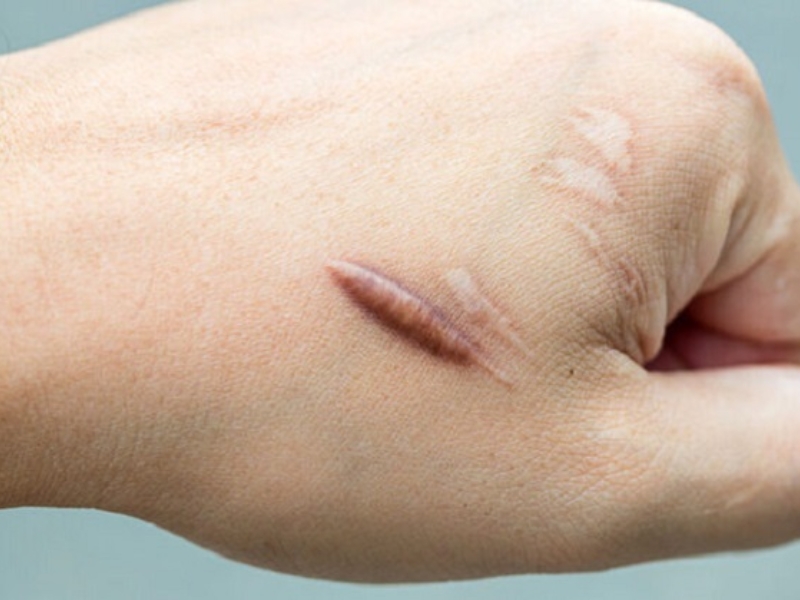 Các triệu chứng của sẹo lồi