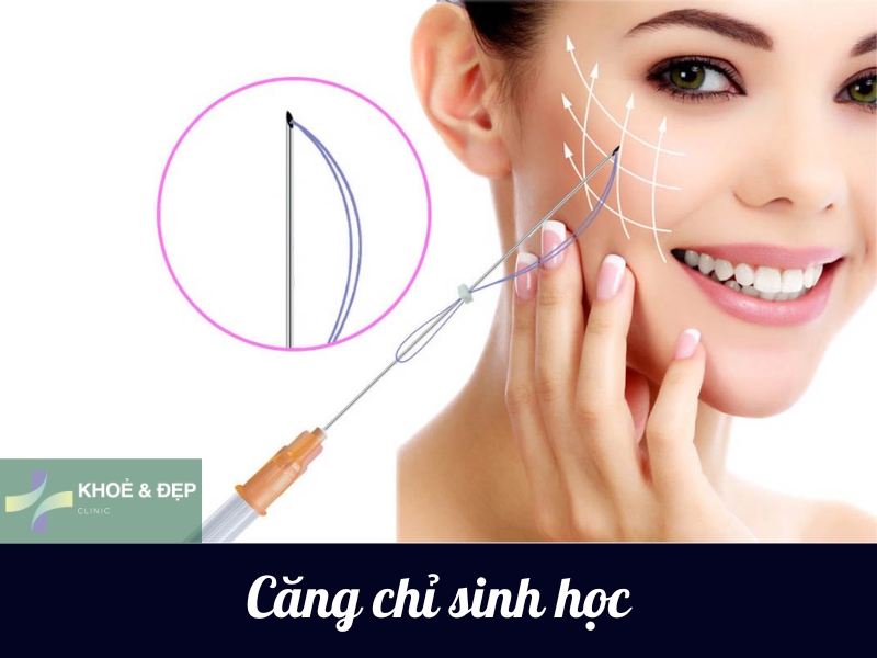 Căng chỉ sinh học trẻ hóa da