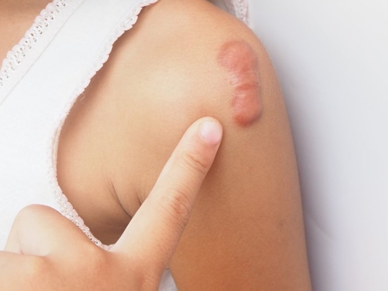 Chẩn đoán sẹo lồi như thế nào?