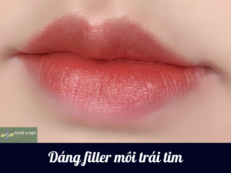 Tiêm filler môi hình trái tim