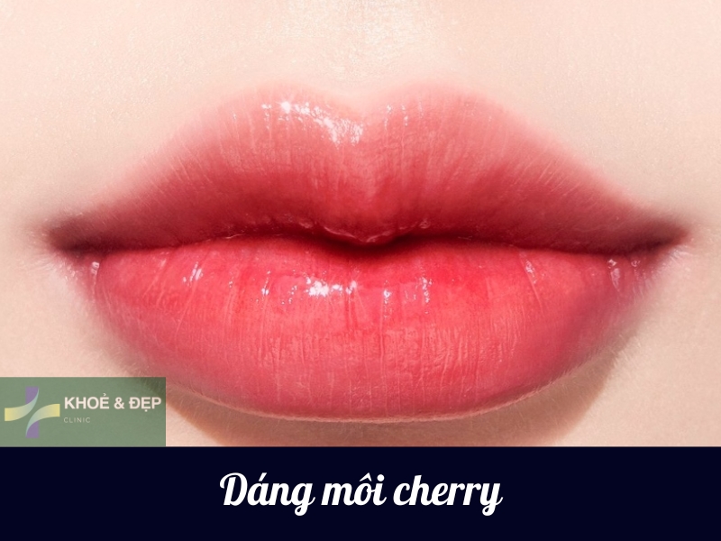 Tiêm filler môi cherry