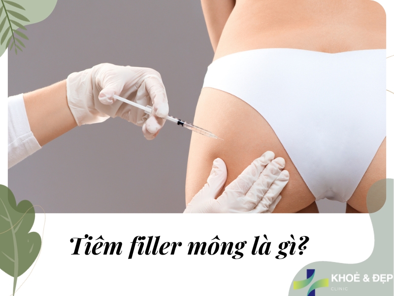 Tiêm filler mông là gì?