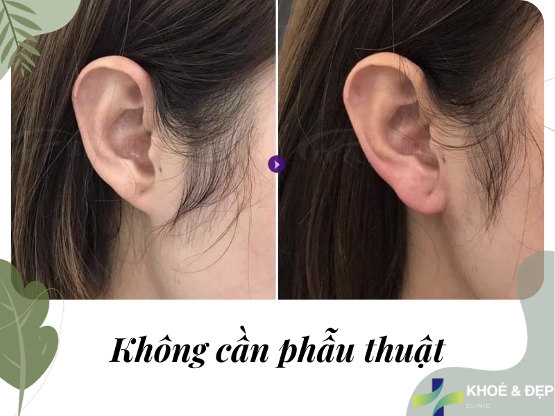 Không cần phẫu thuật