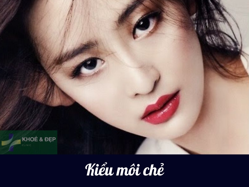 Tiêm filler môi chẻ