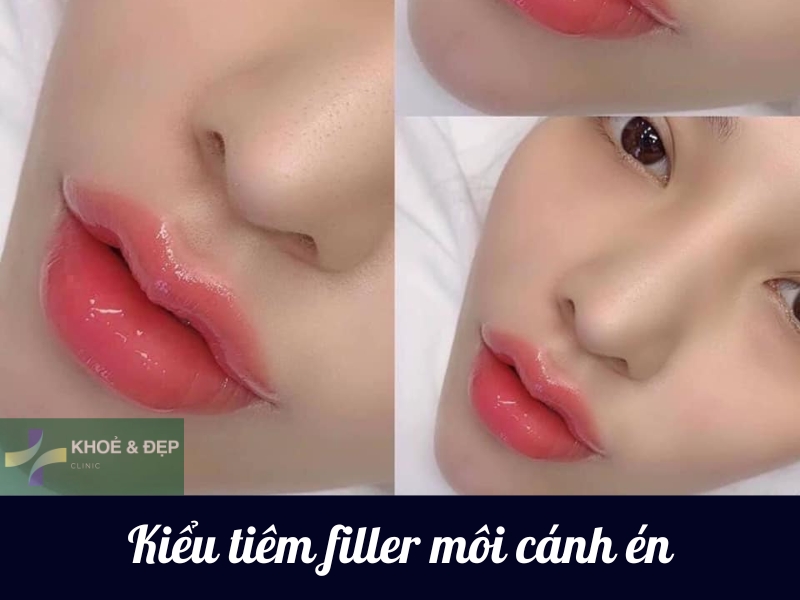 Tiêm môi hình cánh én