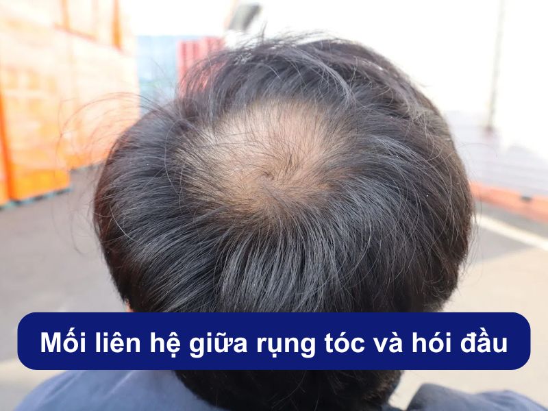 Mối liên hệ giữa rụng tóc và hói đầu