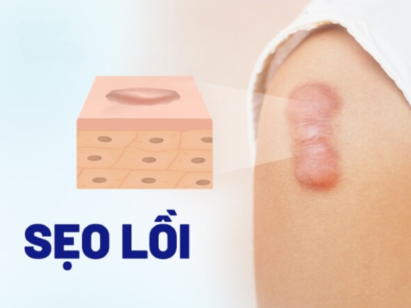 Nguyên nhân hình thành sẹo lồi