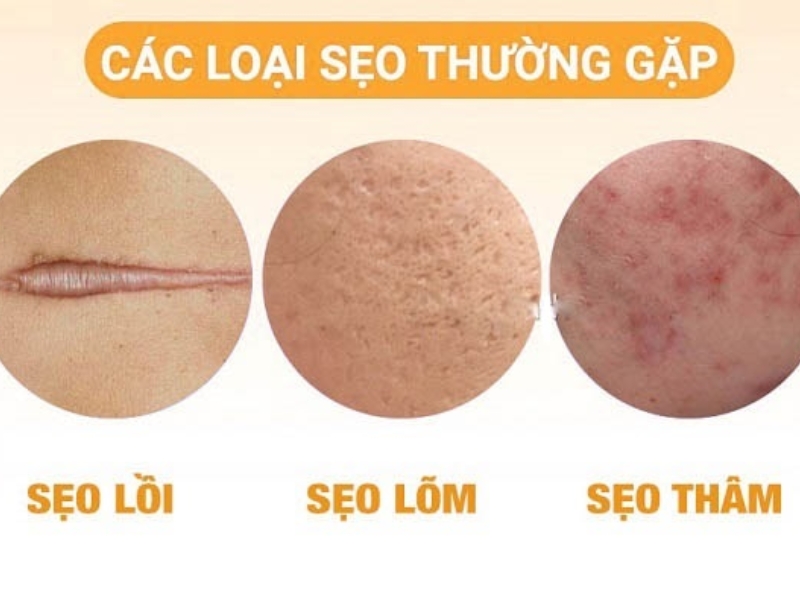 Những loại sẹo thường gặp