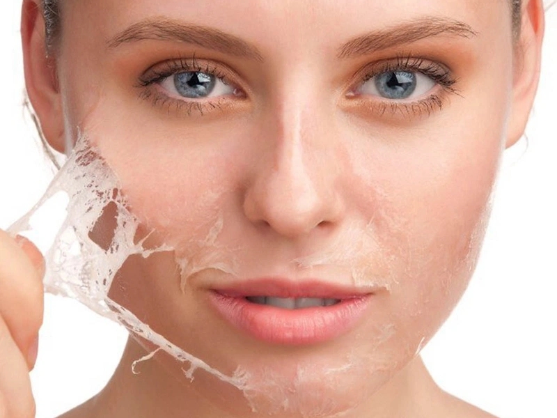 Phương pháp bào mòn da