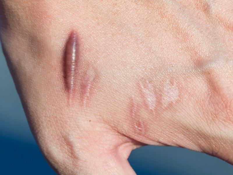 Sẹo lồi là gì?