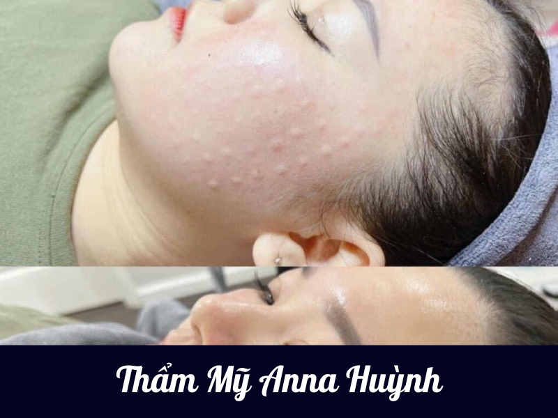Thẩm Mỹ Anna Huỳnh – Địa chỉ tiêm filler tại Nha Trang